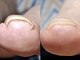 ナチュラ(natura)の写真/日本トラブルネイルケア協会認定サロン☆牽引機や矯正器具に頼らないプロの技術で巻き爪を解決◎