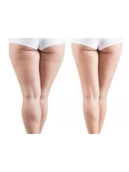 太モモ・ヒップまわりをケアしたい