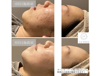 ラヴィオーラ 川崎(La Viora)/ダイヤモンドハーブピーリング