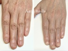 アーティネイルズ(Aaty Nails)/【深爪矯正】ハンド