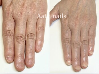 【深爪矯正】ハンド