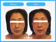 トウメイコガオ 横浜店/トウメイコガオで小顔エステ