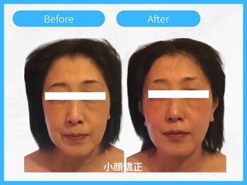 トウメイコガオ 横浜店/トウメイコガオで小顔エステ