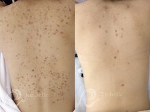 まいれ整骨院 大津市堅田院 マイレ 堅田店(MAILE)/背中ニキビケア