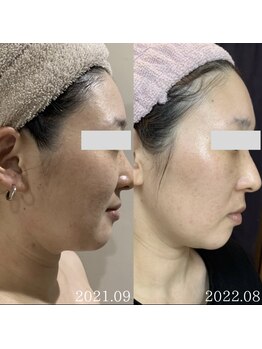 エステサロンブランシュ(Esthe salon Blanche)/ハーブピーリング＋ホームケア