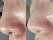 ダリア(Dahlia)/毛穴エクストラクション