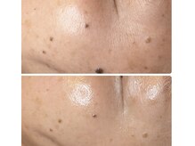 美容液ケアは美白、シミ、シワさまざまなお肌悩みに！