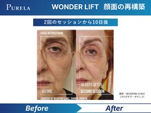 ピュアラ梅田/ワンダーリフトコース