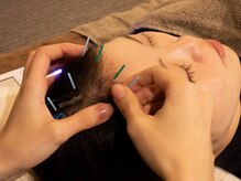 オウユ(OUYU)/頭への鍼施術