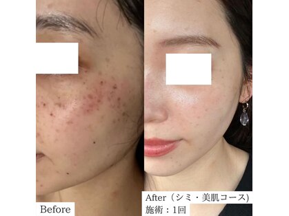 【医師監修】シミ/毛穴/たるみケア専門店 Frohの写真