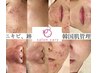 【メニューに悩んだら】LDM水玉リフティング（肌診断付）25,000→12800