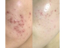 サロン アンネ(Anne)/VOSサロンケアニキビケア