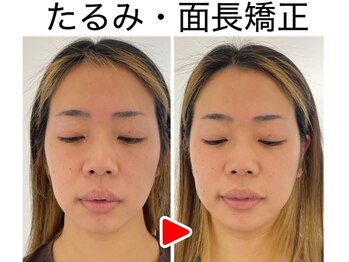 エレヴィザ トウキョウ 恵比寿院(ELVISA TOKYO)/たるみ・面長改善 / 初回施術