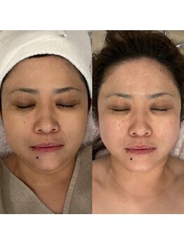 メナードフェイシャルサロン 丸の内ヒルズの写真/中顔面短縮効果◎たるみ・毛穴・くすみ・リフトアップ全てが1度で叶う
★【アドバンス+LRパック¥6600】