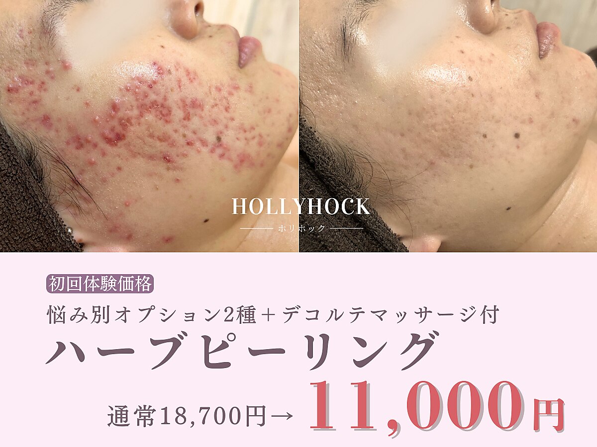 広島市南区で光フェイシャルが人気のエステサロン｜ホットペッパー