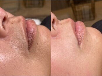 モーヴサロンエトフルール(mauve salon.et.fleurs)/フェイシャルワックス・顔脱毛