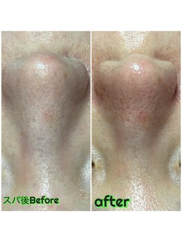 ビービー(BB)/#毛穴洗浄