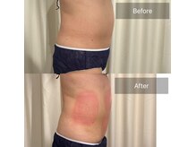 ティープラス 大和鶴間店(T-PLUS)の雰囲気(【エステ】脂肪冷却痩身4カップ☆施術1回ビフォーアフター写真)