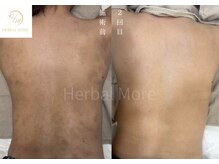 何回で変わる？おすすめの施術回数