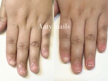 アーティネイルズ(Aaty Nails)/【深爪矯正】ハンド