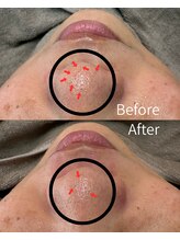 エヌクレアール(Ncrear)/鼻の黒ずみにもアプローチ！