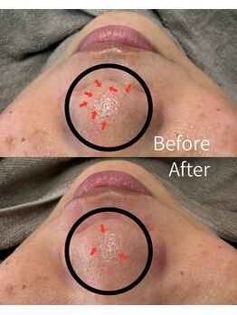 エヌクレアール(Ncrear)/鼻の黒ずみにもアプローチ!