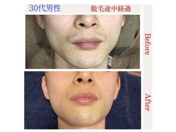 トータルケアーサロン アクア 時津(AQUA)/脱毛：ビフォーアフター２