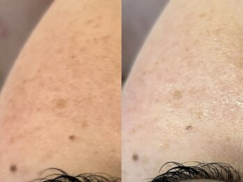 ビューティービレッジ(Beauty village)/顔脱毛/IPL/SHR