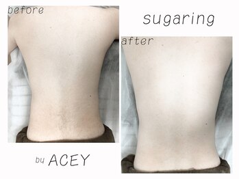 エイシー(ACEY)/ビフォーアフター☆背中