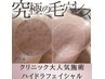 【毛穴黒ずみ】美容ク〇ニックで大人気♪毛穴洗浄ハイドラフェイシャル8900