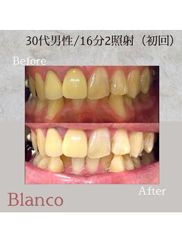 ブランコ 川口店(Blanco)/症例写真☆2セット初回