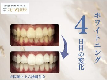 シアホワイト(CIA WHITE)/劇的ビフォーアフター