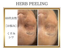 ロージー(ROSY)/ハーブピーリング/阿南/徳島