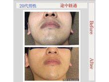 トータルケアーサロン アクア 時津(AQUA)/脱毛：ビフォーアフター３