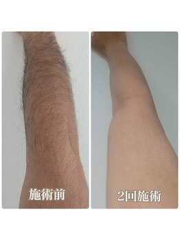 フェリス(FELIZ)/2回目施術後4週間経過