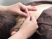 リアン 目黒駅(Re-Ane)/【鍼灸】首肩