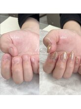 ネオン(Ne.)/深爪矯正 ＊ before after