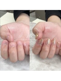 深爪矯正 ＊ before after