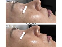 ココロ(COCORO)/プラピール1回施術