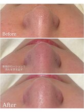 ピュア 川越店/毛穴プレミアムコース