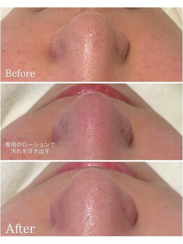 ピュア 川越店/毛穴プレミアムコース