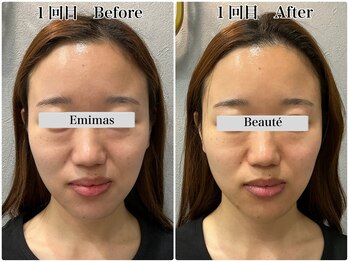 エミマス ボーテ(Emimas Beaute’)/３０代半ば　小顔矯正＆毛穴洗浄