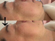 サロン ドロップ 上小田井(Salon drop)/「シミ改善」途中経過