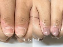 アーティネイルズ(Aaty Nails)/【深爪矯正】ハンド