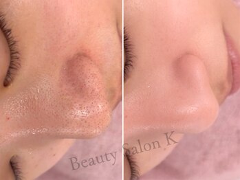 ケイ(K)の写真/【防府エステ】ニキビ・毛穴開き・黒ずみぜーんぶまるごと解決◎1回の効果と通いやすい定額メニューあり◎