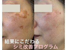 ユーブルーム(youbloom)