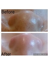 フロレゾン(Floraison)/毛穴エクストラクション