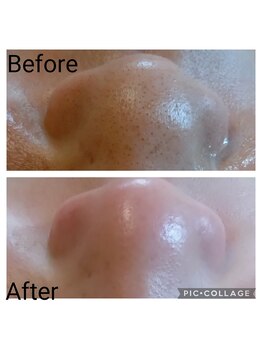 フロレゾン(Floraison)/毛穴エクストラクション