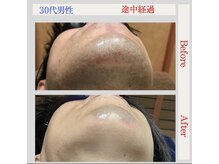 トータルケアーサロン アクア 時津(AQUA)/脱毛：ビフォーアフター４