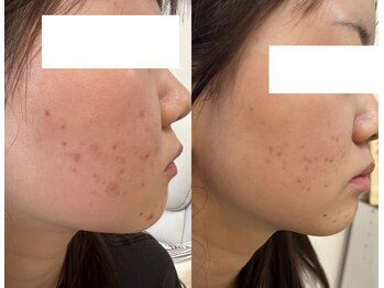 デューン 蕨店(Dune)/before/after10代後半女性